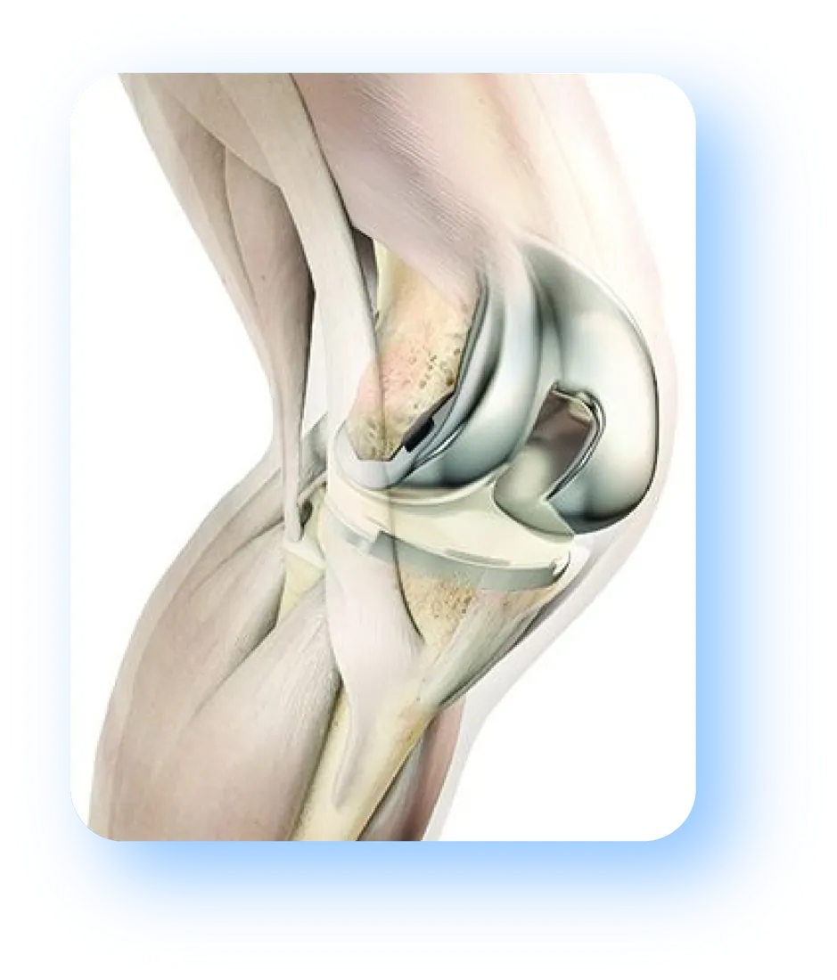 Ilustración: prótesis de rodilla