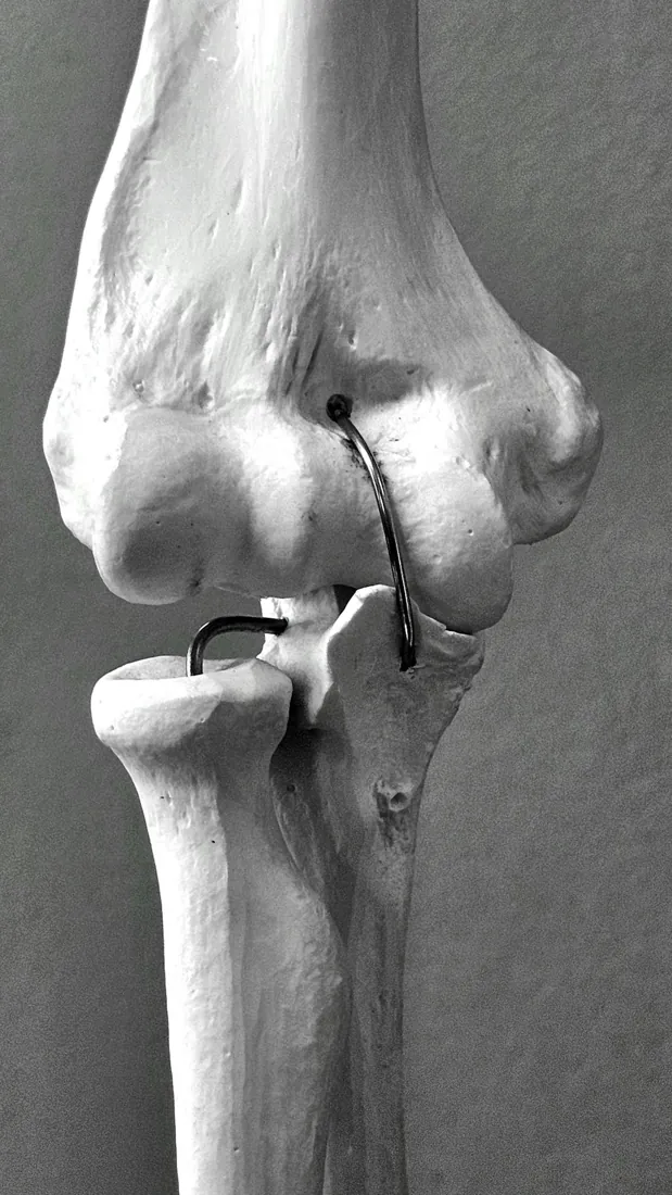 Lesiones de ligamentos